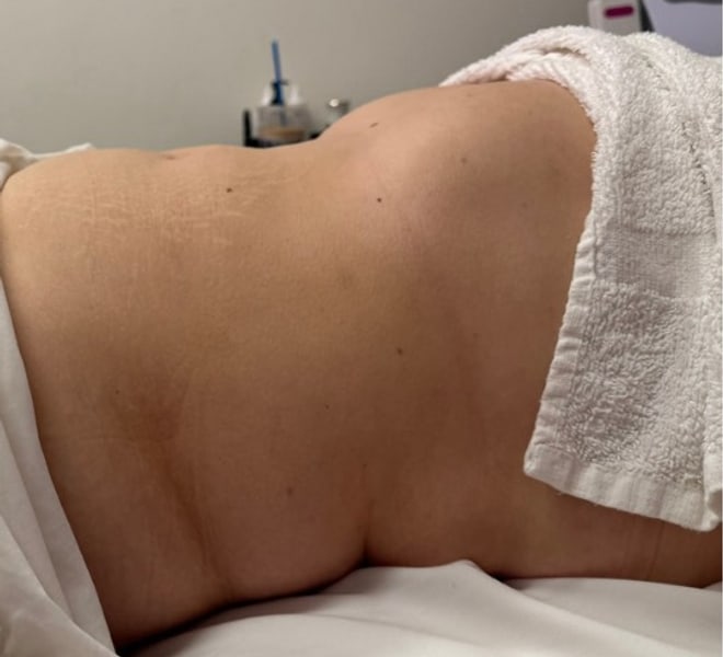 Client before one Brazilian Lymphatic treatment
