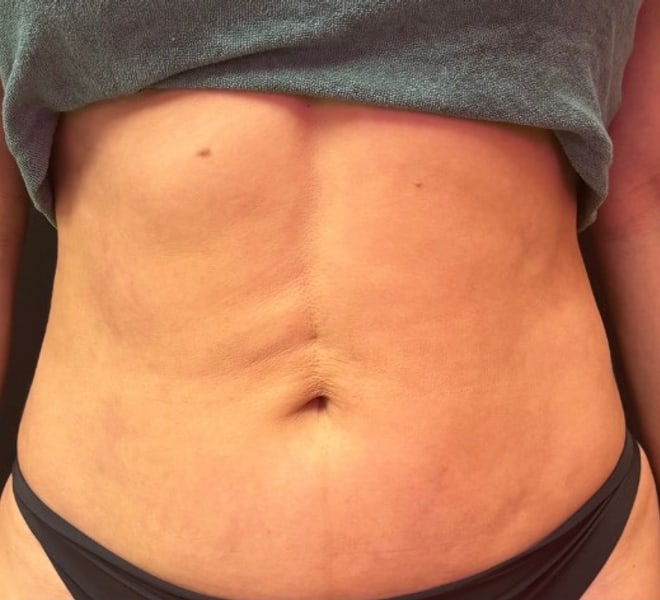 Client before three Signature Stomach Sculpting sessions