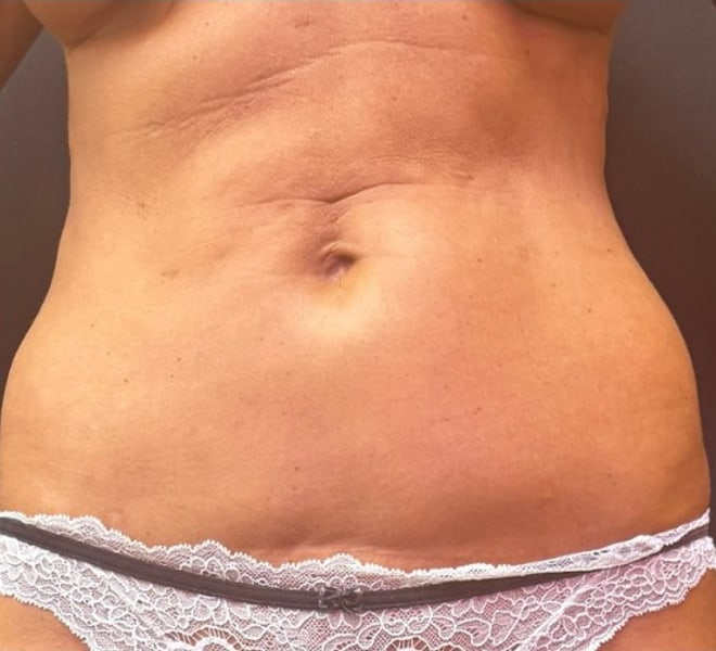 Client before seven Lymphatic Trio treatments